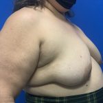 Tissue Expander To Implant Breast Reconstruction Before & After Patient #5638