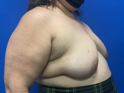 Tissue Expander To Implant Breast Reconstruction Before & After Patient #5638