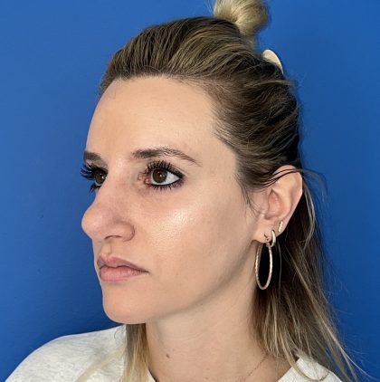 Rhinoplasty Before & After Patient #5612