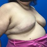 Tissue Expander To Implant Breast Reconstruction Before & After Patient #5638