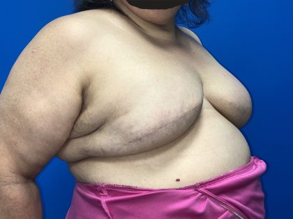 Tissue Expander To Implant Breast Reconstruction Before & After Patient #5638