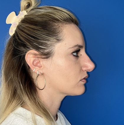 Rhinoplasty Before & After Patient #5612