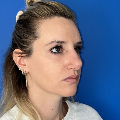 Rhinoplasty Before & After Patient #5612
