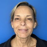 CO2 Laser Before & After Patient #5602