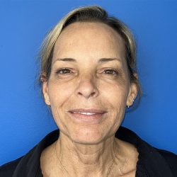 CO2 Laser Before & After Patient #5602