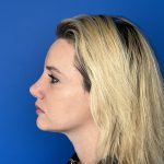 Rhinoplasty Before & After Patient #5612