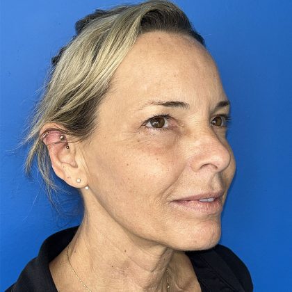 CO2 Laser Before & After Patient #5602
