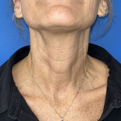 CO2 Laser Before & After Patient #5602