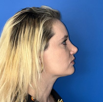 Rhinoplasty Before & After Patient #5612
