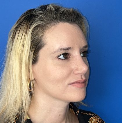 Rhinoplasty Before & After Patient #5612