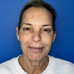 CO2 Laser Before & After Patient #5602