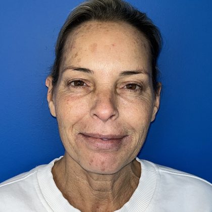 CO2 Laser Before & After Patient #5602