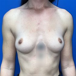 Breast Augmentation Before & After Patient #5630