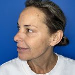 CO2 Laser Before & After Patient #5602