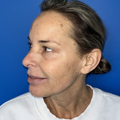 CO2 Laser Before & After Patient #5602