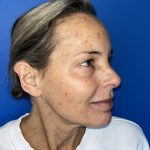 CO2 Laser Before & After Patient #5602