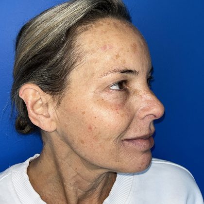 CO2 Laser Before & After Patient #5602