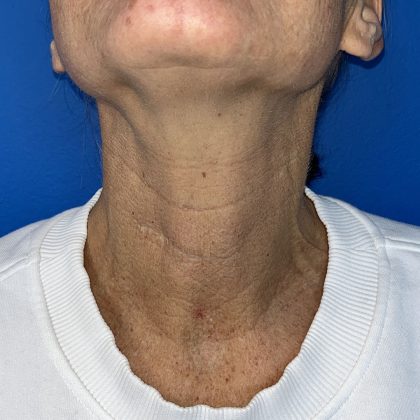 CO2 Laser Before & After Patient #5602