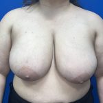 Breast Reduction Before & After Patient #5652