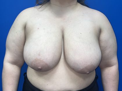 Breast Reduction Before & After Patient #5652