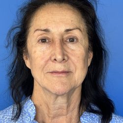CO2 Laser Before & After Patient #5666