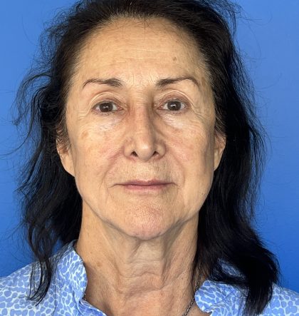 CO2 Laser Before & After Patient #5666