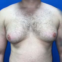Gynecomastia Before & After Patient #5645