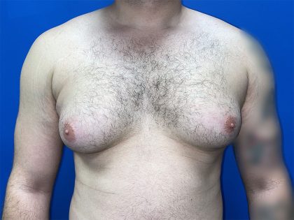 Gynecomastia Before & After Patient #5645