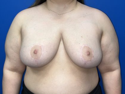 Breast Reduction Before & After Patient #5652