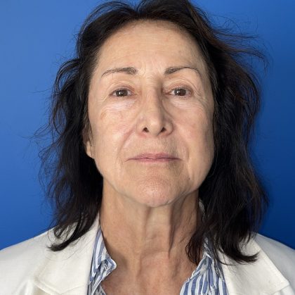 CO2 Laser Before & After Patient #5666