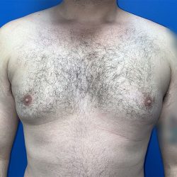Gynecomastia Before & After Patient #5645