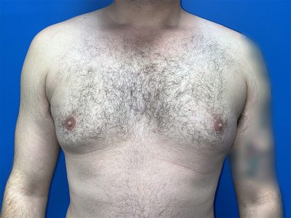 Gynecomastia Before & After Patient #5645