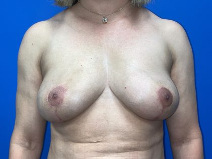 Breast Explant Before & After Patient #5659
