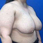 Breast Reduction Before & After Patient #5652