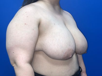 Breast Reduction Before & After Patient #5652