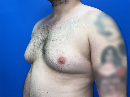 Gynecomastia Before & After Patient #5645