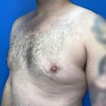 Gynecomastia Before & After Patient #5645