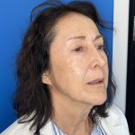 CO2 Laser Before & After Patient #5666