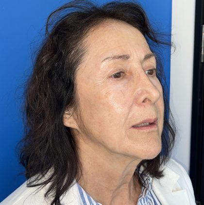 CO2 Laser Before & After Patient #5666