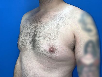 Gynecomastia Before & After Patient #5645