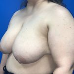 Breast Reduction Before & After Patient #5652