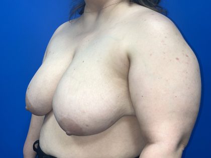 Breast Reduction Before & After Patient #5652