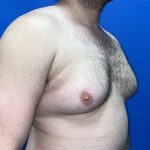 Gynecomastia Before & After Patient #5645