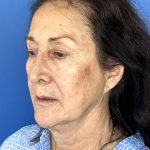CO2 Laser Before & After Patient #5666