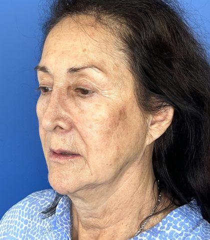 CO2 Laser Before & After Patient #5666