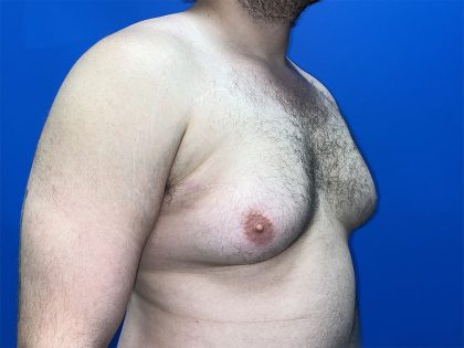 Gynecomastia Before & After Patient #5645