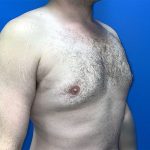Gynecomastia Before & After Patient #5645