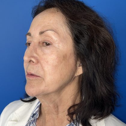 CO2 Laser Before & After Patient #5666