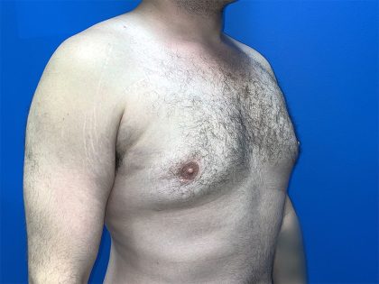 Gynecomastia Before & After Patient #5645