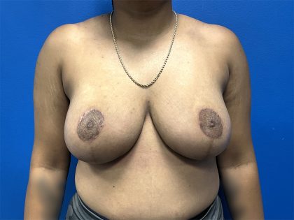 Breast Reduction Before & After Patient #5693